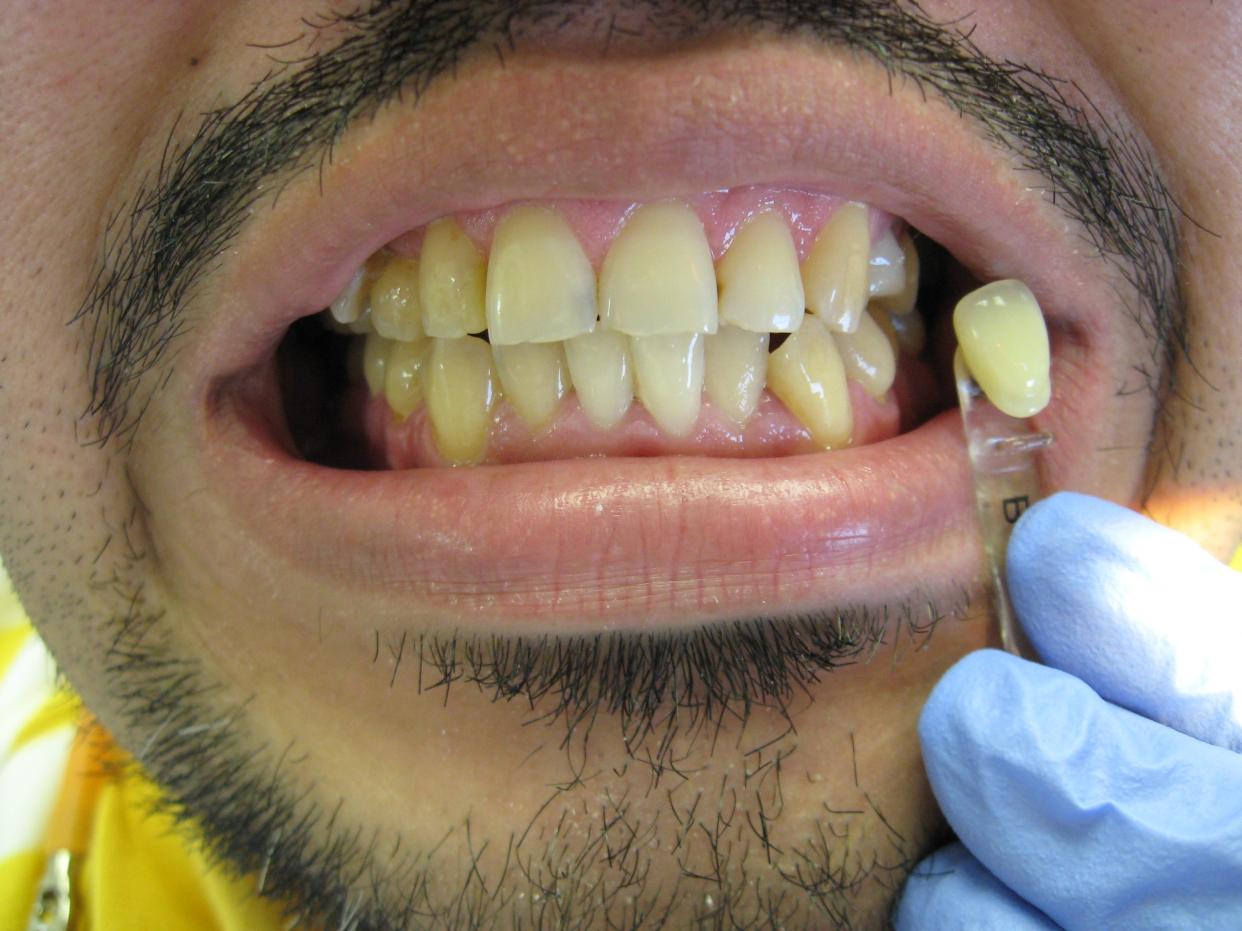 whitening-before